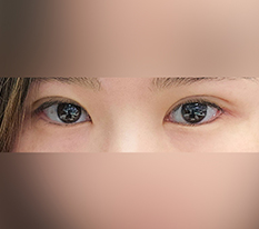 눈수술로 인상이 바뀌었어요