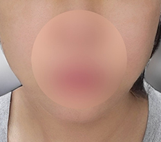 출산 후 실리프팅 받았는데