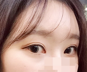 눈수술 짱짱맨>.<