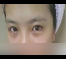 쌍꺼풀(절개) 듀얼트임 넘나맘에들어요:D