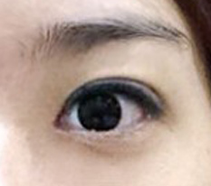 빅아이눈매확장수술 효과 너무 좋네요