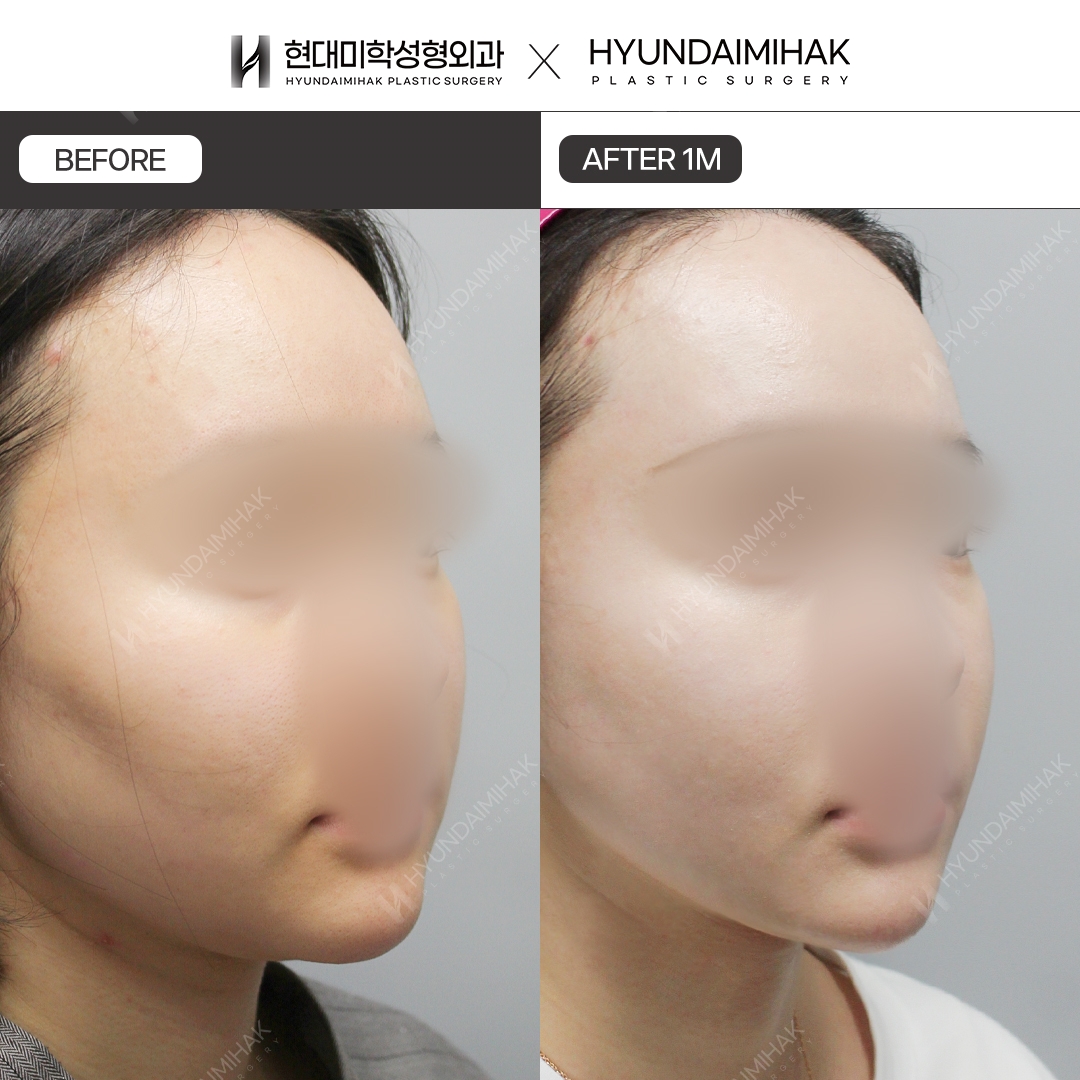 [리프팅] 이중턱 실리프팅 1개월 차