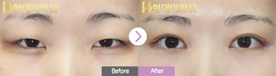 눈절개, 눈매교정, 앞트임, 뒤, 밑트임