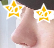 남자는 코! 현대미학성형외과에서 성공했음