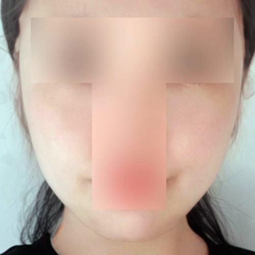 턱살처짐 볼살처짐 실리프팅