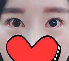 뒤밑트임 재수술했는데 잘 됐는지 봐주세욤