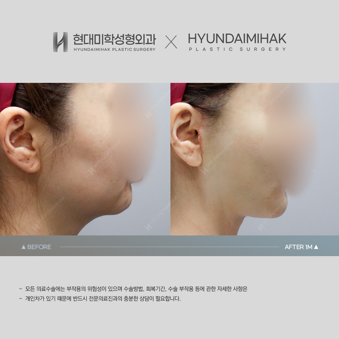 [동안성형] 실리프팅 1개월 차