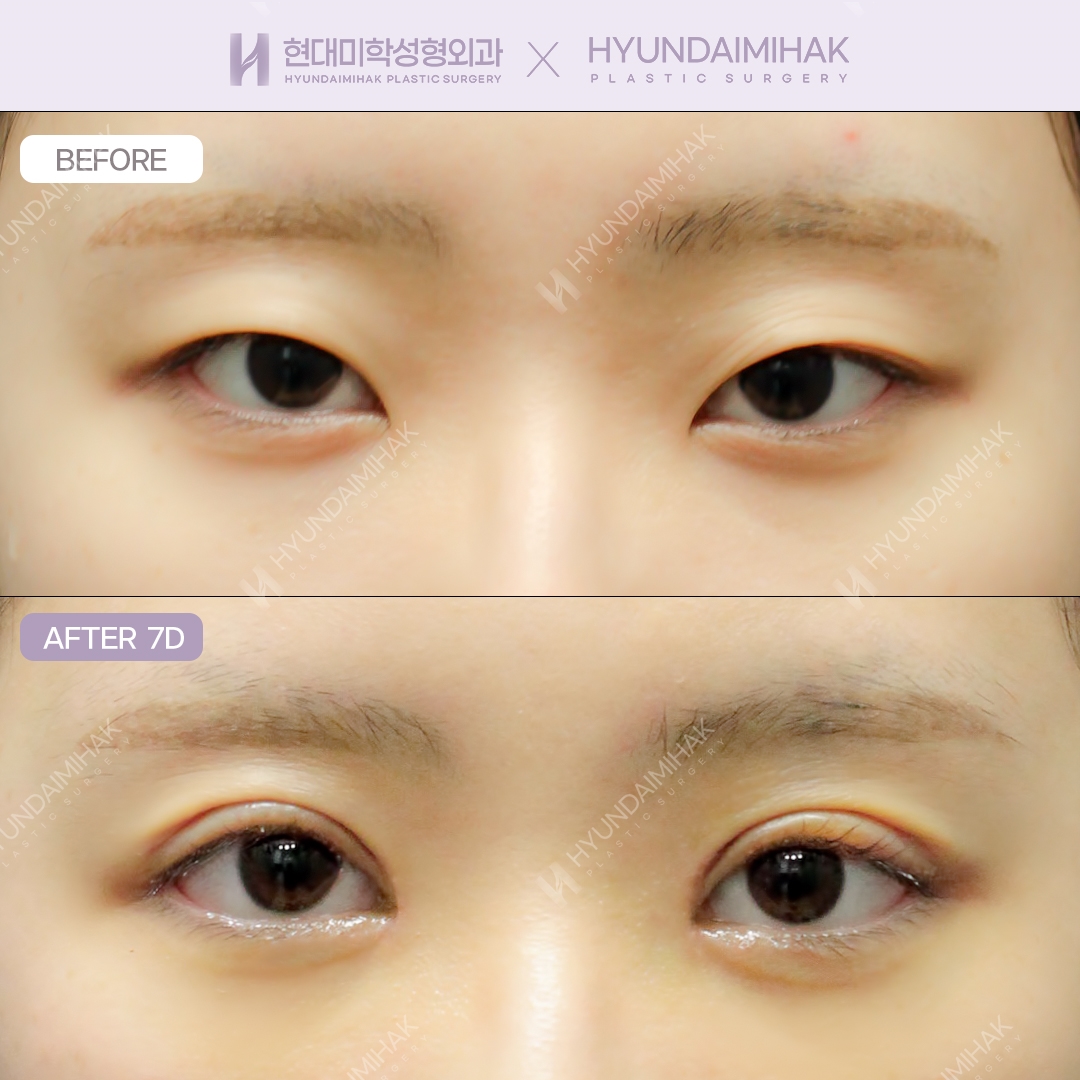 절개쌍꺼풀 + 듀얼트임