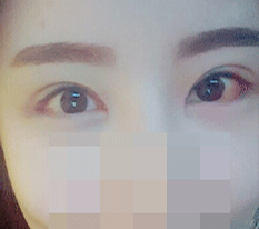 눈재수술+뒷트임+밑트임+앞트임 후기+_+