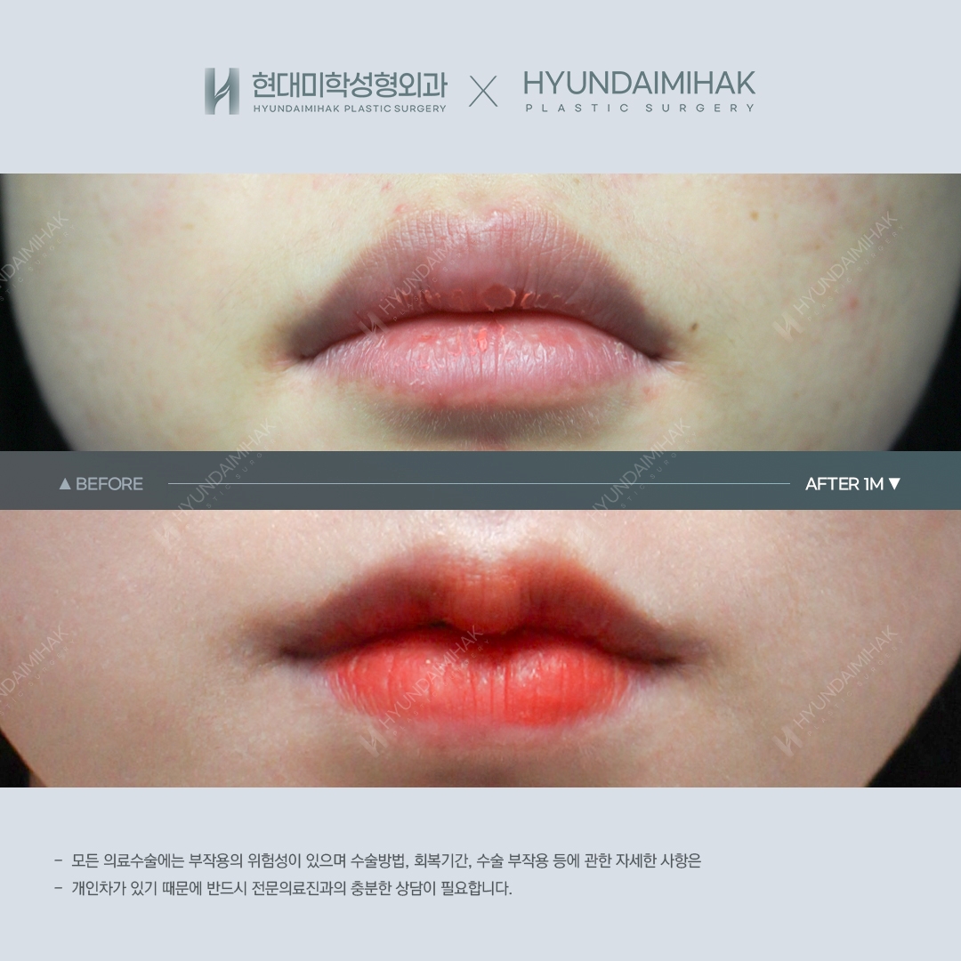 [입술성형] 큐피트 입술성형 1개월 차