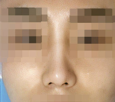 남자코 수술 2달 지난 후기 올려봐요.