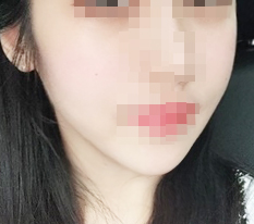 턱끝축소!!후기~