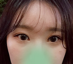 눈매교정이랑 트임으로 이미지변신 성공 :)
