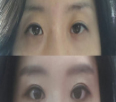 졸린눈 탈출 후기