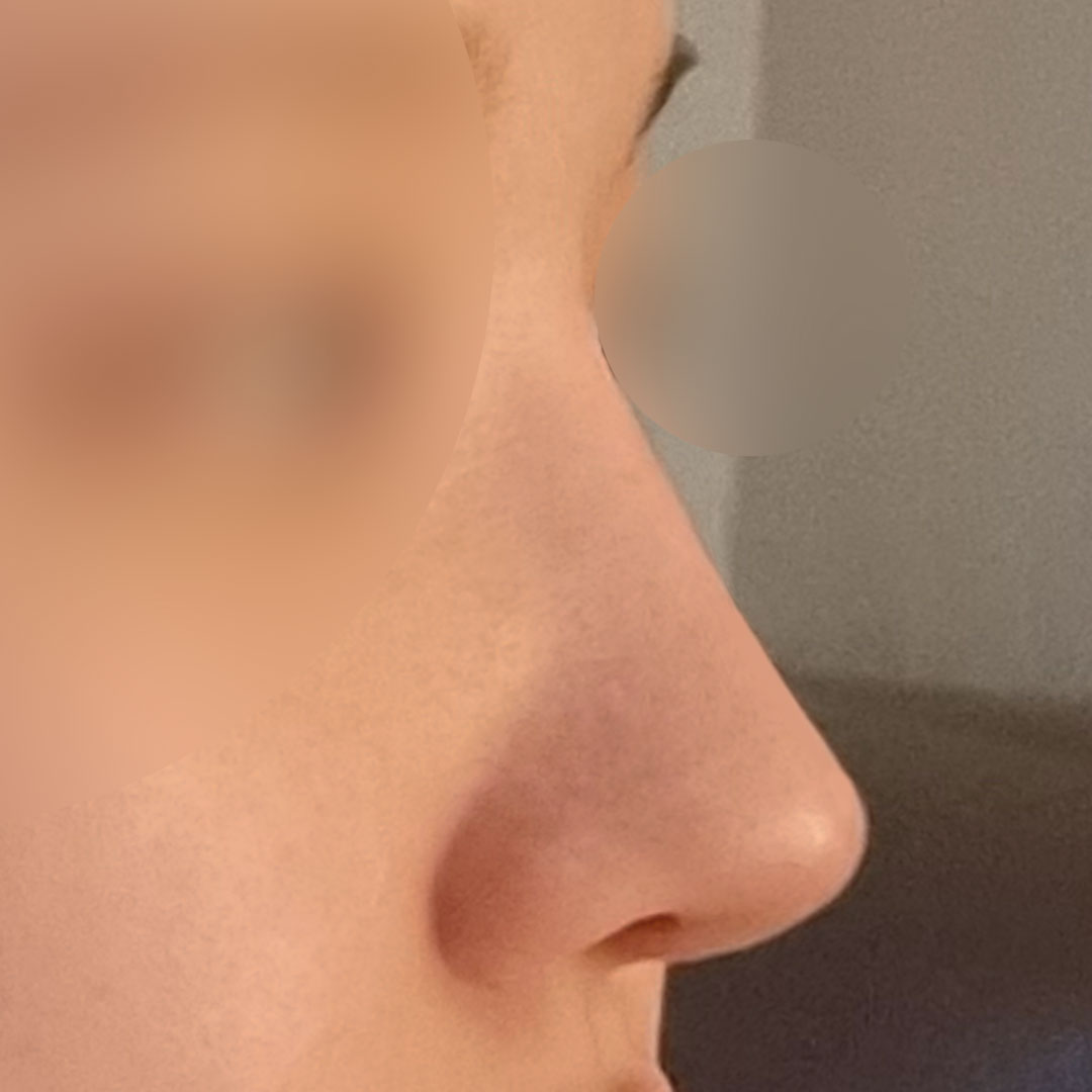 25년 평생 못난이코 코성형 한 후기