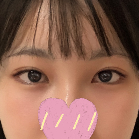 꼬막눈 트임과 쌍꺼풀재수술 후기예요