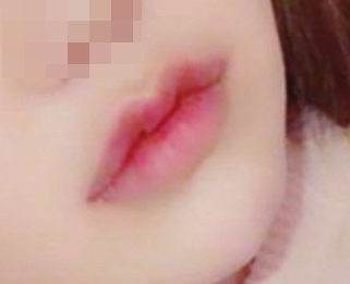 입술성형 신기해요~~
