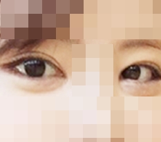 눈재수술이랑풀트임받았떠욤!!