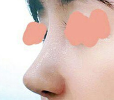코재수술 후기 올려봐요 ㅎㅎ