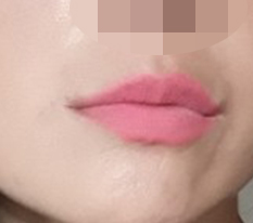 입술성형 어떤가요? 성공한 것 같죠??
