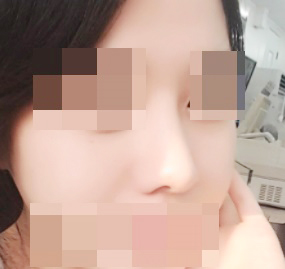 코성형최고 대만족이에요♥!!