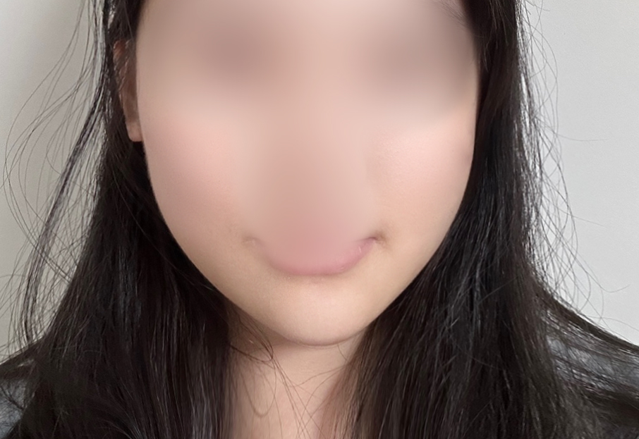 실리프팅으로 안면 비대칭 잡았어요