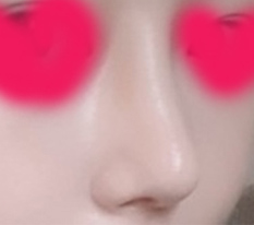 주변 지인들이 제 코 보고 난리 났어요ㅋㅋㅋ