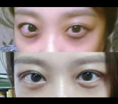 쌍꺼풀 매몰로 찝었어요@_@