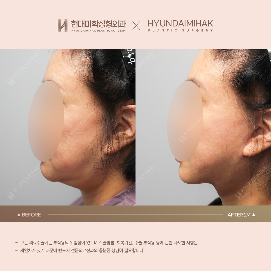[동안성형] 실리프팅 1개월 차