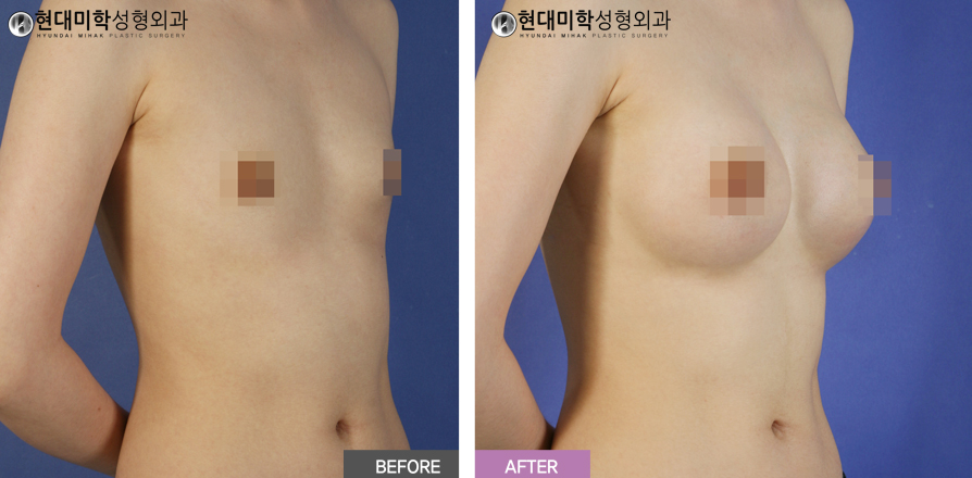 가슴확대수술