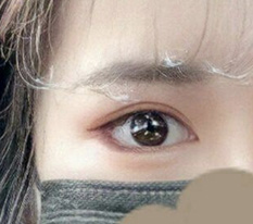 눈재수술한거 잘 된것같죠??