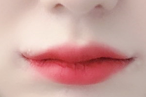 드디어 입꼬리성형 후기 올려요