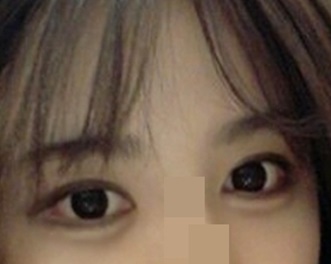 눈성형 후기에요~