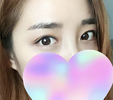 쌍수후기!! 짱잘됐어여 ㅎㅎㅎㅎㅎ