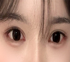 절개쌍수+풀트임으로 화려눈 됐어요