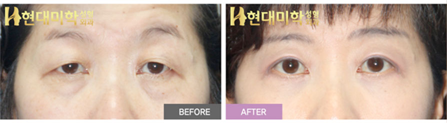 상안검성형술, 눈매교정, 하안검성형술