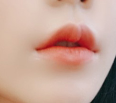 입매 컴플렉스 단박에 해결했어요 ^^