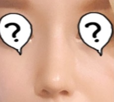 못생겼던 코 현대미학에서 코성형 후 이미지 탈바꿈!