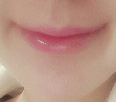 입꼬리+지방이식 후기 ♡