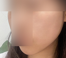 드디어 윤곽주사 후기!