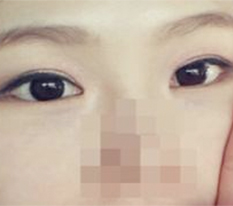 눈수술 만족 후기입니당^.^/