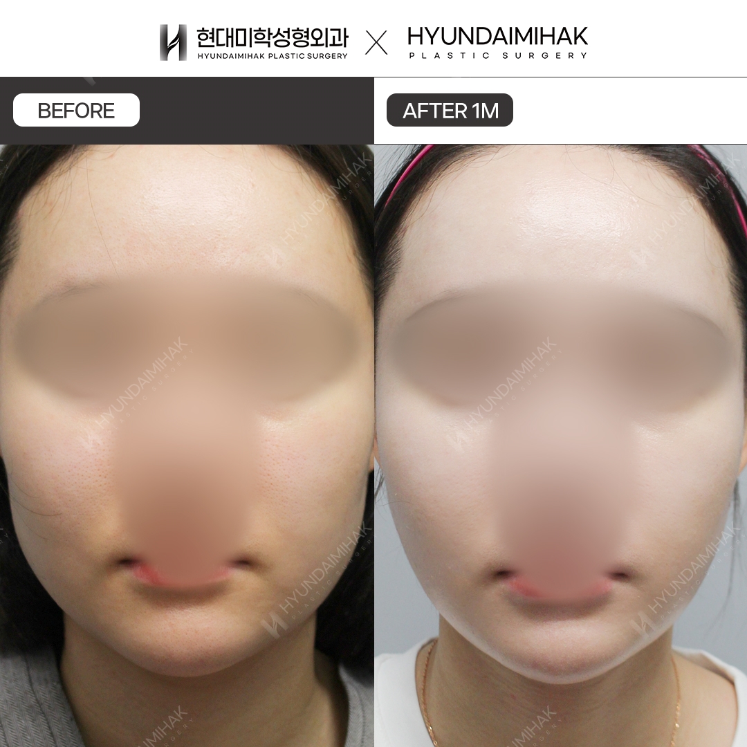 [리프팅] 이중턱 실리프팅 1개월 차
