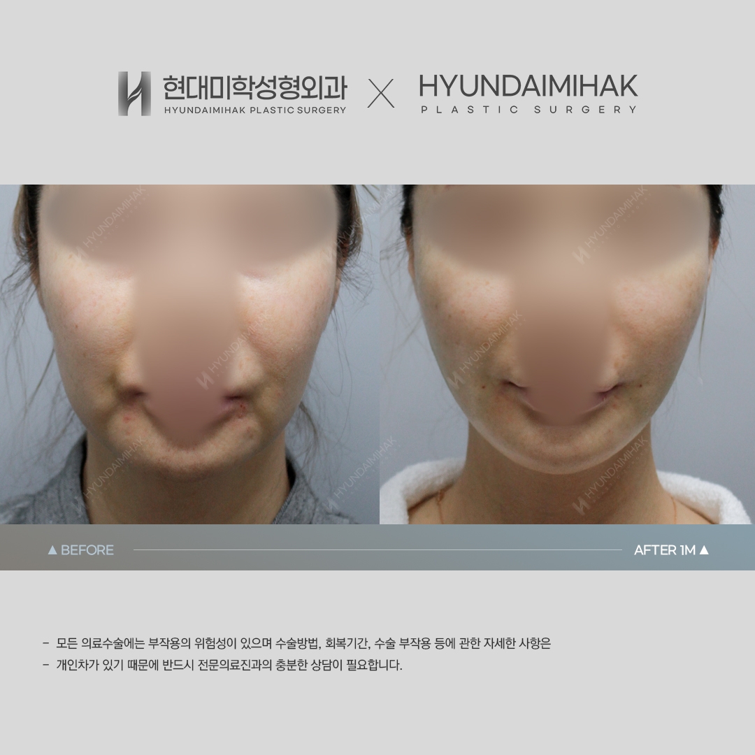 [동안성형] 실리프팅 1개월 차