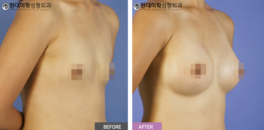 가슴확대수술
