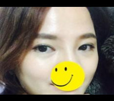 앞트임, 듀얼트임 후기