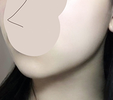 턱살 정리 완