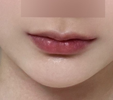 입꼬리수술 하길 잘했네요ㅋㅋㅋ