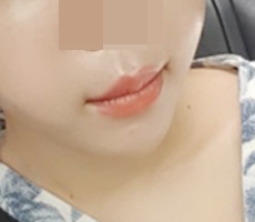 입꼬리성형 이벤트길래 받았어요:D