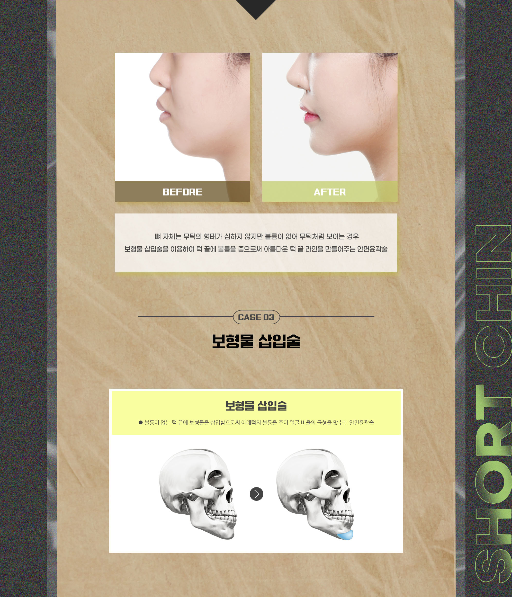 CASE 03 볼륨이 없고 무턱 — 수술 전후 사진과 보형물 삽입술 안내