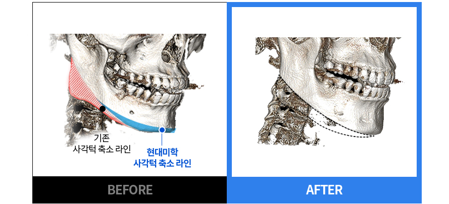 기존 사각턱 라인과 현대미학 사각턱 축소 라인 BEFORE / AFTER CT 비교
